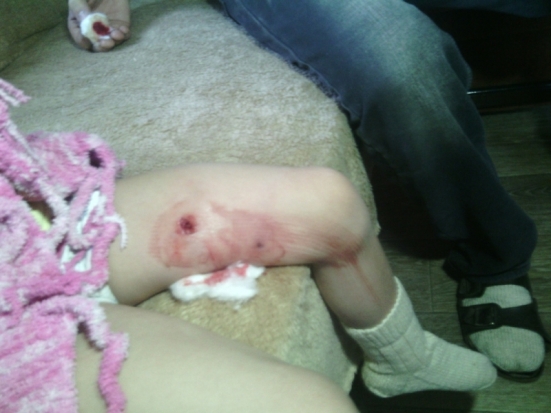 В Пскове две школьницы спасли четырехлетнюю слепую девочку от нападения овчарки (+ видео) - 2017-01-18 13:27:00 - 1